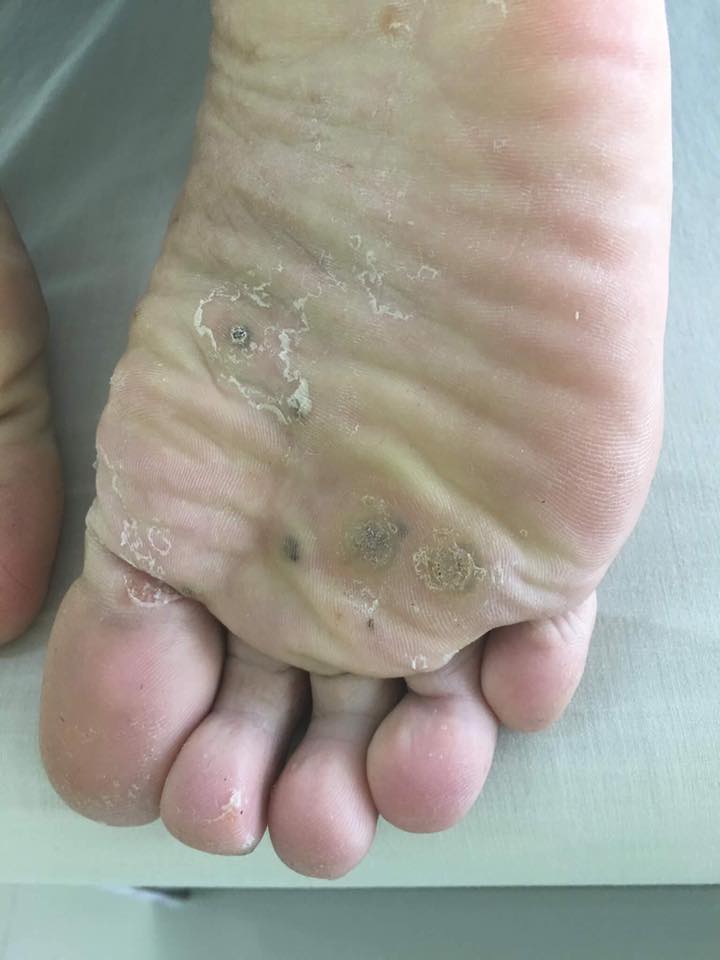 hood foot2